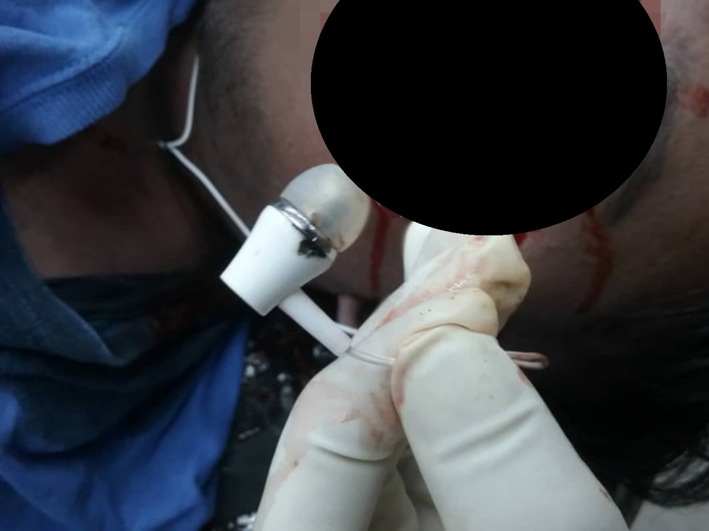青年边充手机边戴耳机瞓觉竟触电!耳仔流血惨死