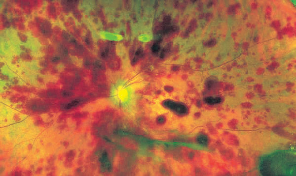 幹細胞療法未驗證 3視障婦變盲