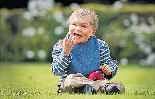 染色體異常 13歲童像3歲孩