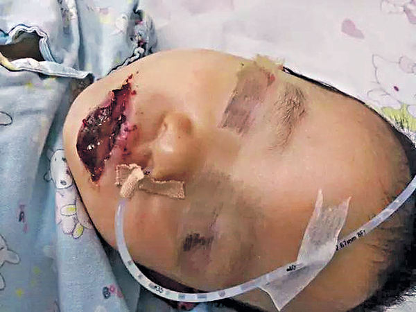 清潔劑當奶粉 2歲女童口唇灼傷