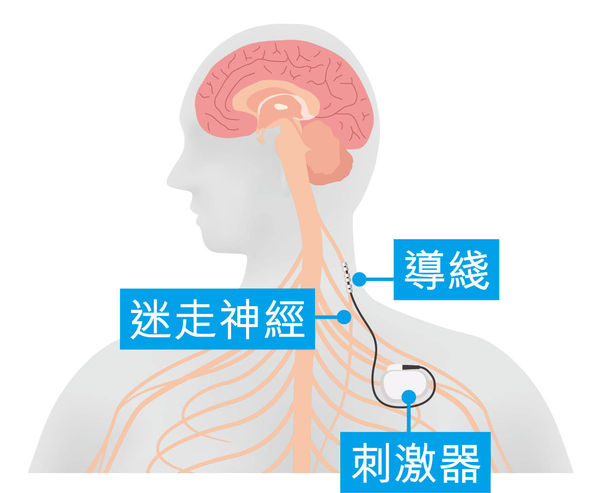 刺激迷走神經 15年植物人恢復知覺
