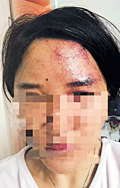 閨蜜互打透明質酸針 1人險盲
