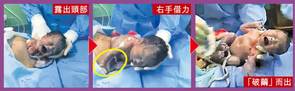 「自然剖腹」片瘋傳 嬰兒借力爬出子宮