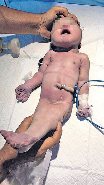 供血營養不足引發 「美人魚BB」僅活4小時