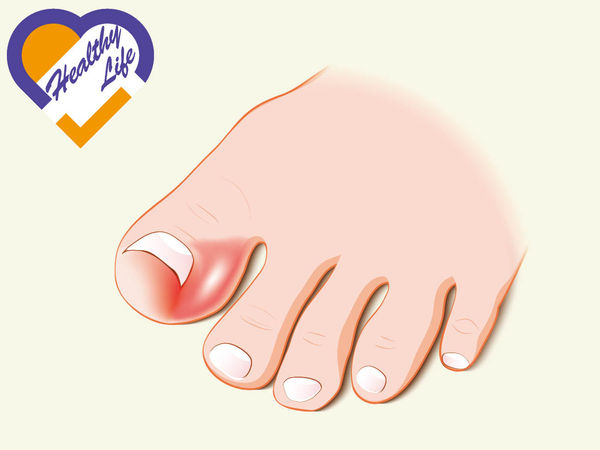 成日着忍者鞋 隨時生「雞眼」