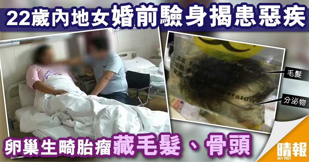 22歲女婚前驗身揭患惡疾 卵巢生畸胎瘤藏毛髮、骨頭