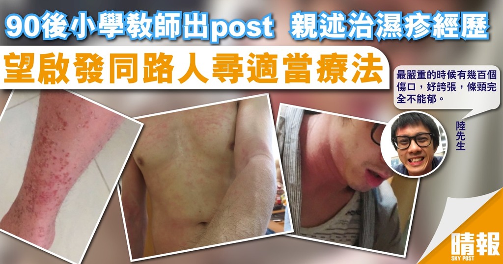 90後小學教師出post  親述治濕疹經歷 望啟發同路人尋適當療法