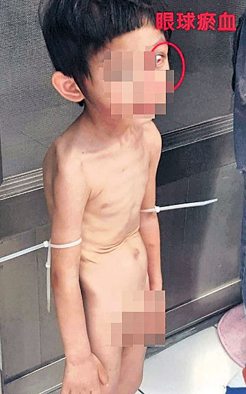 台3歲童受虐全身瘀傷 餓到吃糞便