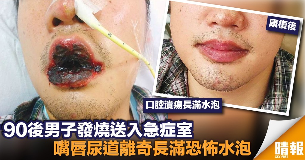 26歲男子發燒入院 口腔長滿水泡擴散眼睛陰莖