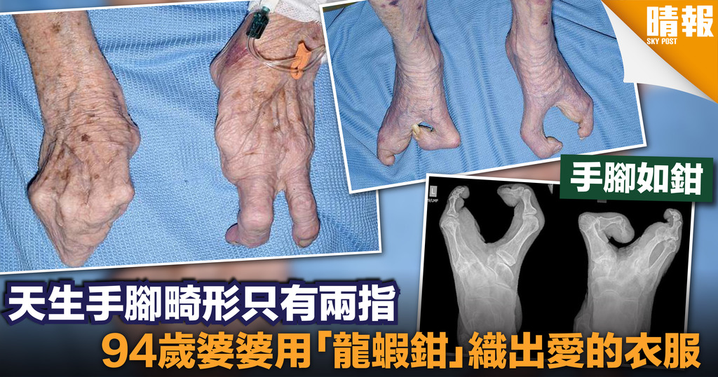 94歲婆婆天生手腳畸形 活了近一世紀用「龍蝦鉗」照顧兒子
