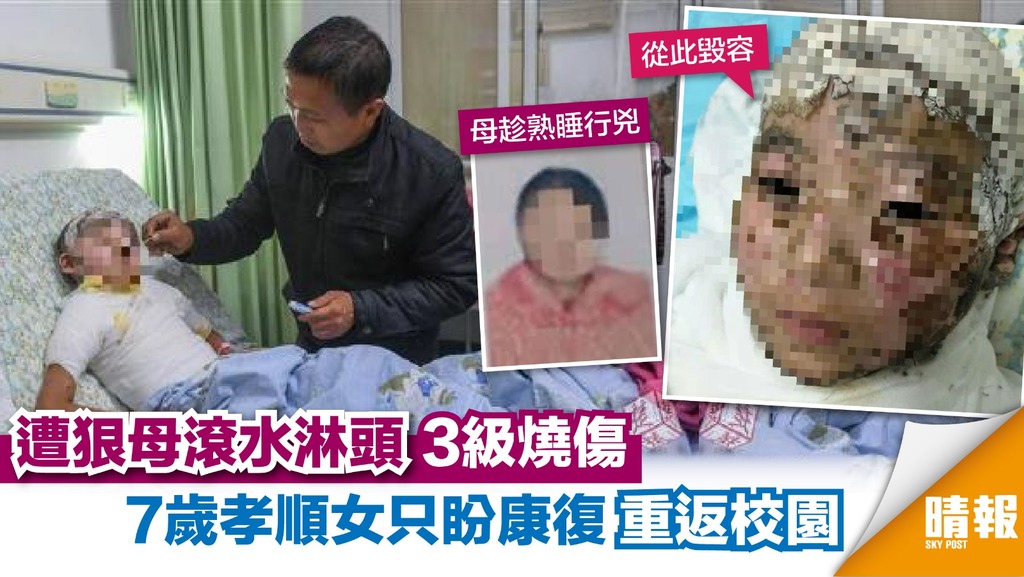遭狠母滾水淋頭3級燒傷 7歲女只盼康復重返校園