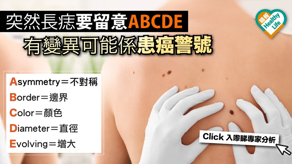 痣會演變成皮膚癌? 醫生提出ABCDE法則檢查痣的變異