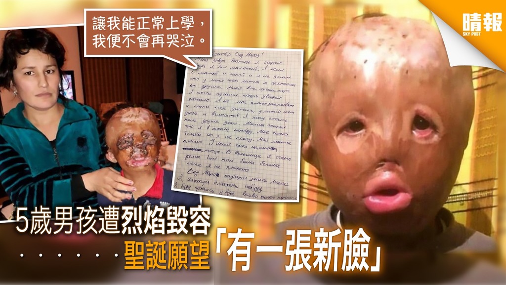 5歲男孩遭烈炎毀容 盼「有正常的臉」上學去