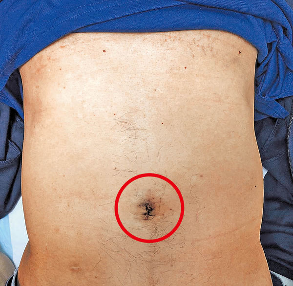 中大望引入 新機械臂微創手術 幾乎無傷口減感染