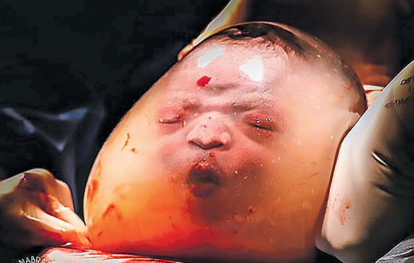 未穿羊水出世 男嬰「異形」相爆紅
