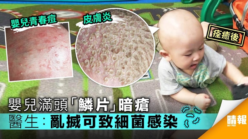 嬰兒滿頭「鱗片」暗瘡 醫生：亂搣可致細菌感染