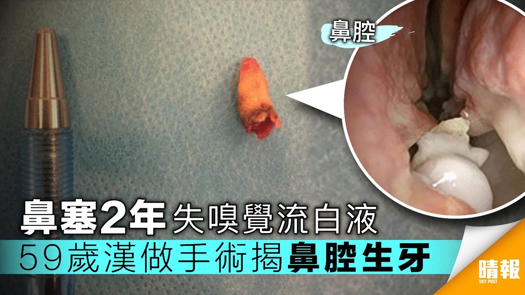 恐怖！59歲男鼻塞2年失嗅覺 做手術驚揭鼻腔有隻牙