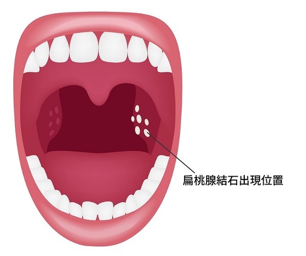 網上扁桃腺結石大賽粒粒白色珍珠醞釀終極口臭醫生 嚴重時會導致扁桃腺發炎 晴報 健康 耳鼻喉專區 D