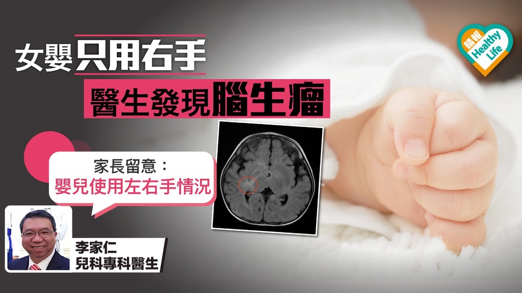 11個月大女嬰慣只用右手惹懷疑 入院檢查竟發現腦生瘤 