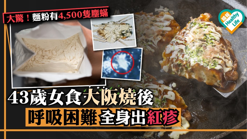 43歲女食大阪燒呼吸困難全身出紅疹 全因麵粉存放不當！