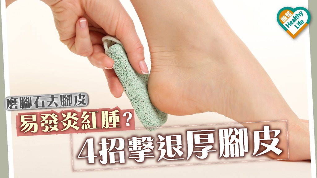 磨腳石去腳皮易細菌感染發炎紅腫 4招擊退厚腳皮 還原嫩滑雙腳