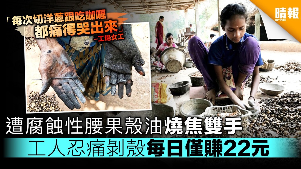遭腰果殼油腐蝕燒焦雙手 工人忍痛剝殼1公斤僅賺2.2元