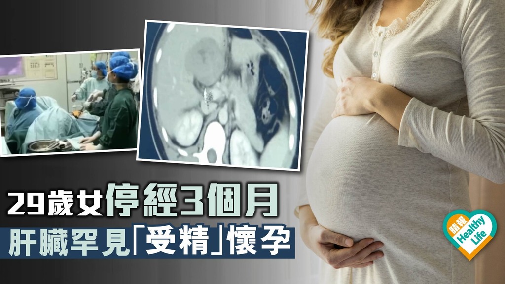 29歲女停經3個月 肝臟罕有宮外孕 生命受威脅