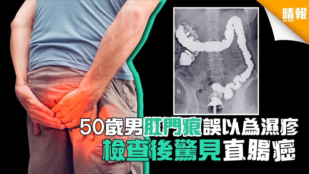 50歲男肛門痕誤以為濕疹 檢查後驚見直腸癌 