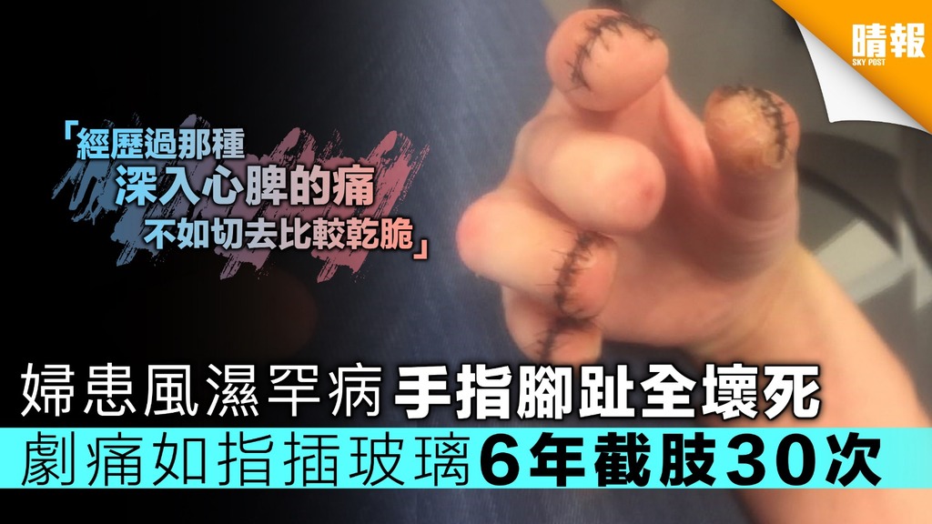 婦患風濕罕病手指腳趾全壞死 劇痛如指插玻璃6年截肢30次