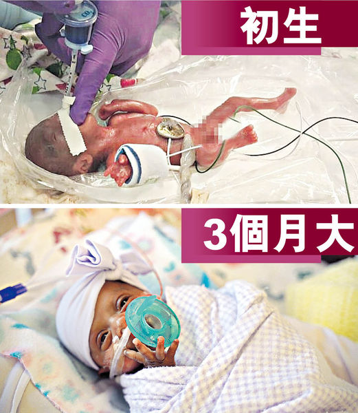 全球最小嬰兒健康出院