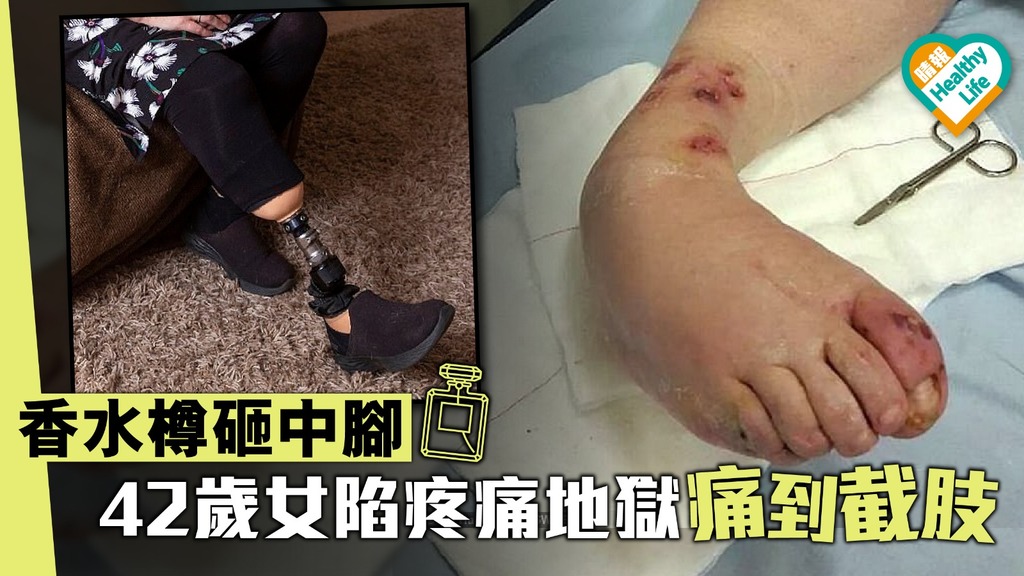 香水樽砸中腳 42歲女陷疼痛地獄痛到截肢
