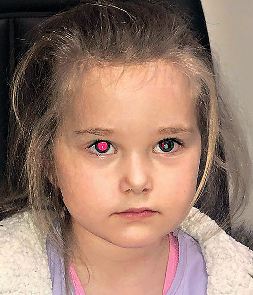 瞳孔現白色斑點 澳洲4歲女患眼癌