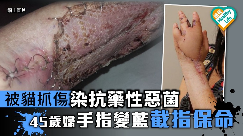45歲婦被貓抓傷染抗藥性惡菌 手指腫脹變藍截指保命