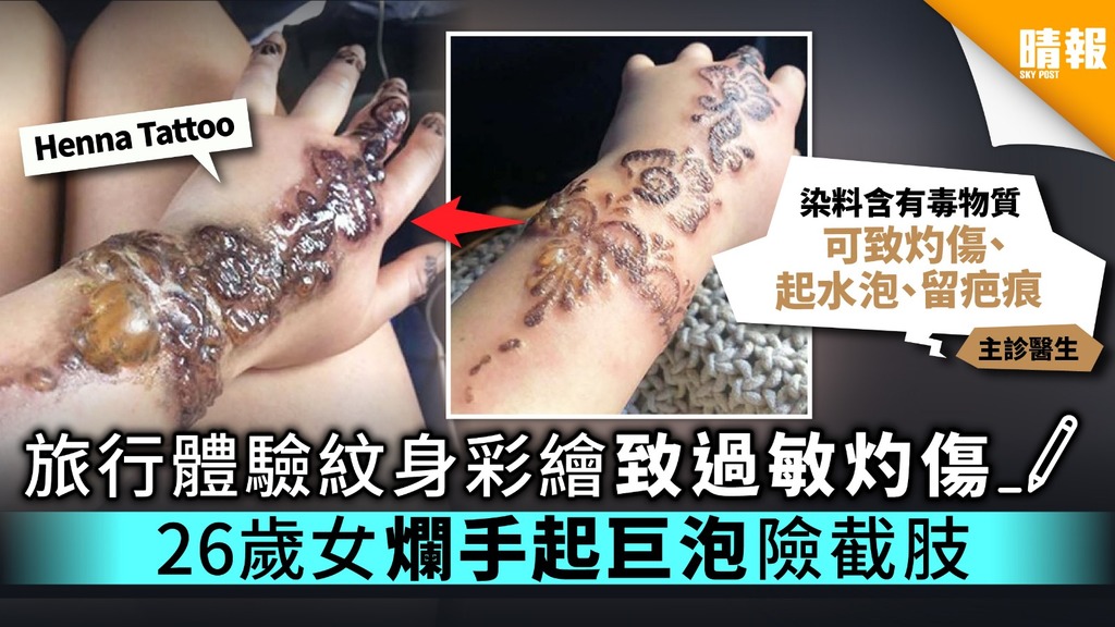 旅行體驗紋身彩繪致過敏灼傷 26歲女爛手起巨泡險截肢