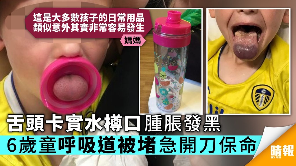 舌頭卡實水樽口腫脹發黑 6歲童呼吸道被堵急開刀保命