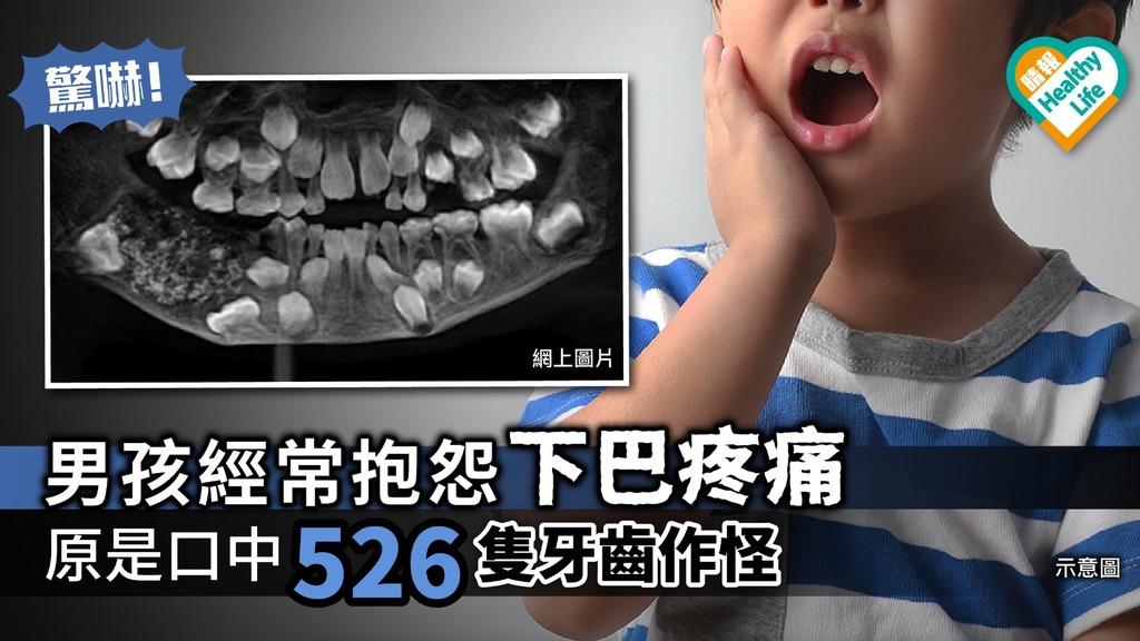 驚嚇！男孩經常抱怨下巴疼痛 原是口中526隻牙齒作怪