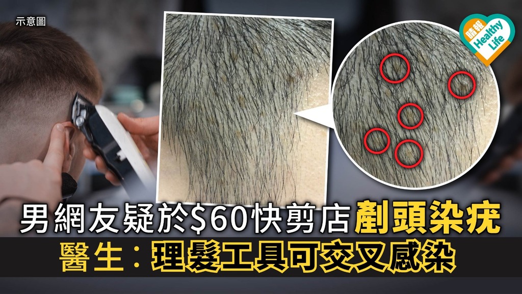 【快剪中伏】男網友疑於$60快剪店剷頭染疣 醫生︰理髮工具可交叉感染