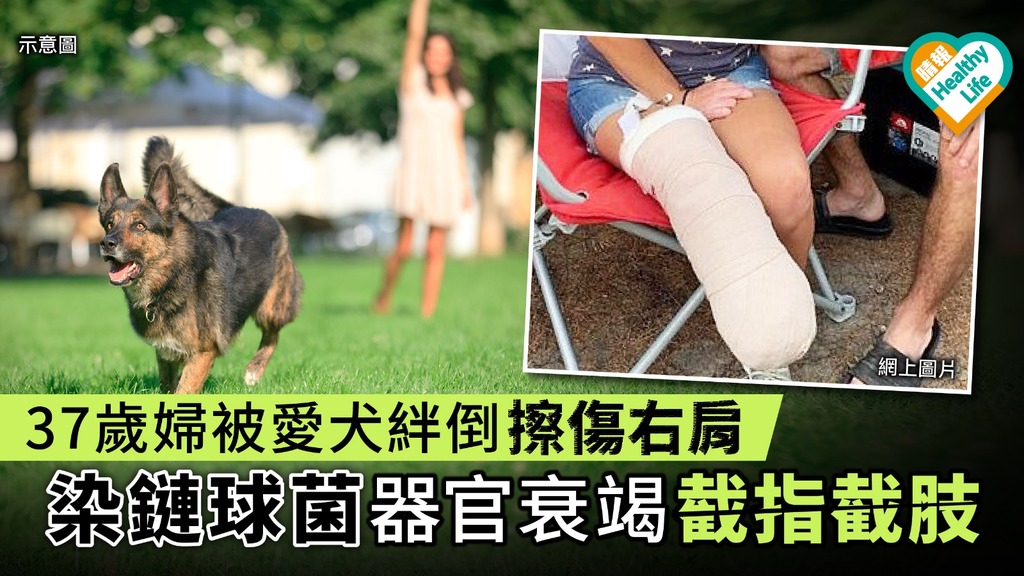 37歲婦被愛犬絆倒擦傷右肩 染鏈球菌器官衰竭截指截肢