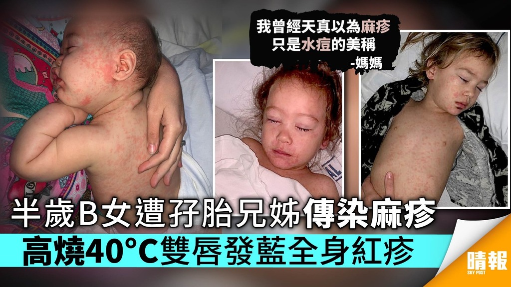 半歲B女遭孖胎兄姊傳染麻疹 高燒40°C雙唇發藍全身紅疹
