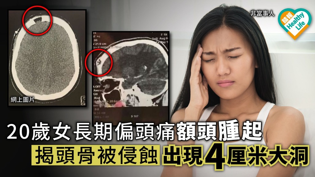 20歲女偏頭痛額頭腫起 揭頭骨被侵蝕出現4厘米大洞