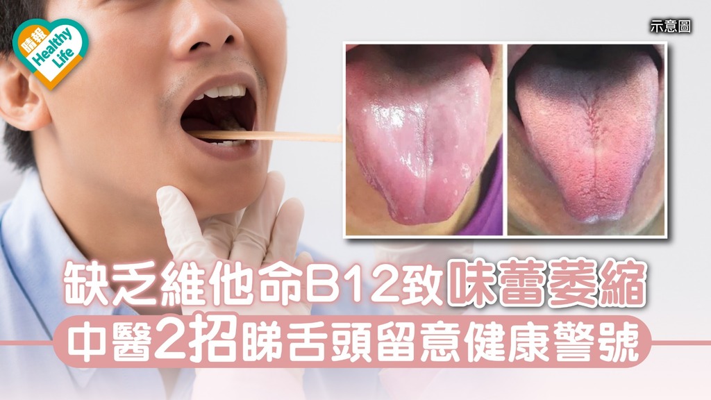 缺乏維他命B12致味蕾萎縮 中醫2招睇舌頭留意健康警號