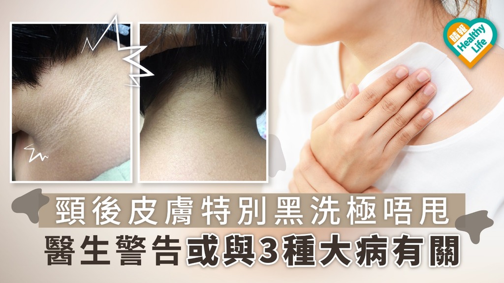 頸後皮膚特別黑洗極唔甩 醫生警告或與3種大病有關