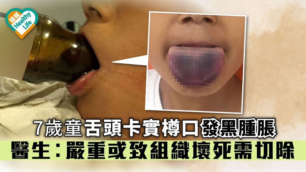 7歲童舌頭卡實樽口發黑腫脹 醫生︰嚴重或致組織壞死需切除