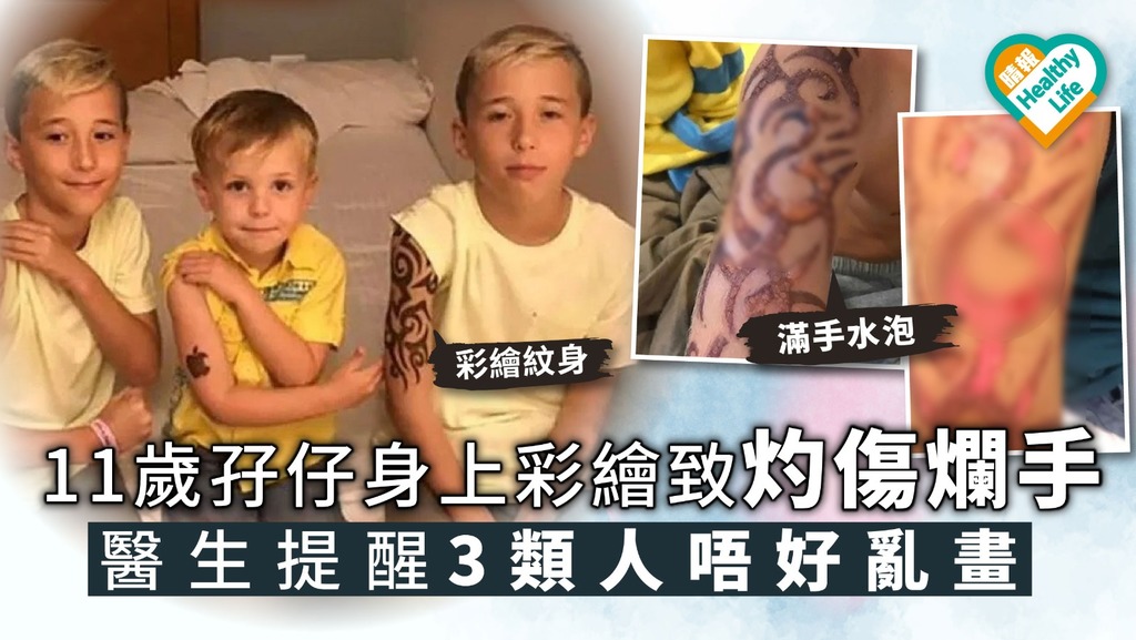 【彩繪紋身】11歲孖仔身上彩繪致灼傷爛手 醫生提醒3類人唔好亂紋