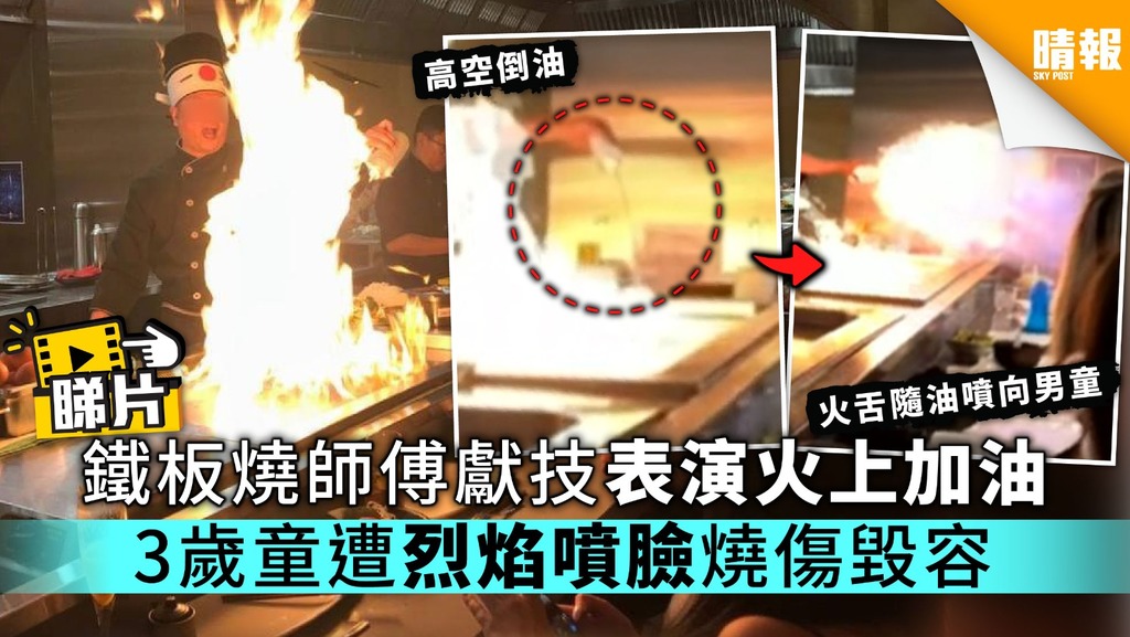 【恐怖意外】鐵板燒師傅獻技表演火上加油 3歲童遭烈焰噴臉燒傷毀容