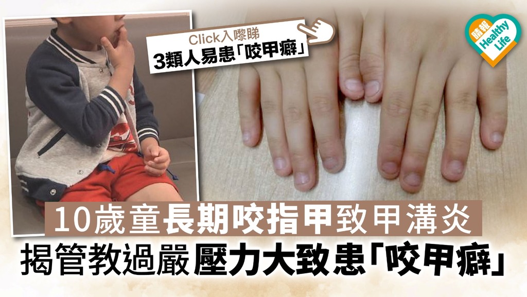 10歲童長期咬指甲致甲溝炎 揭管教過嚴 壓力大致患「咬甲癖」
