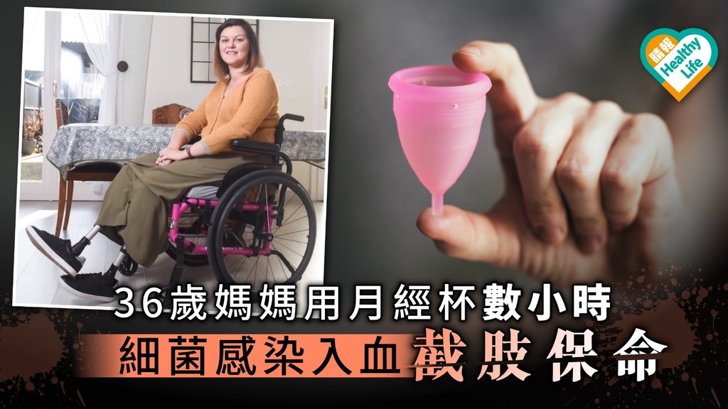 【女士衛生】36歲媽媽用月經杯數小時 細菌感染入血截肢保命