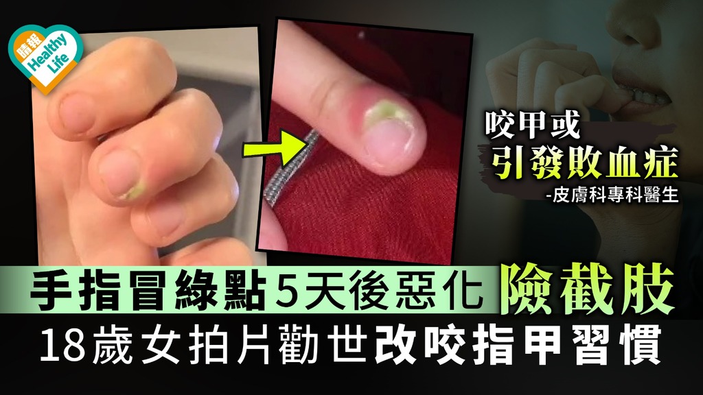 手指冒綠點5天後惡化險截肢 18歲女拍片勸世改咬指甲習慣