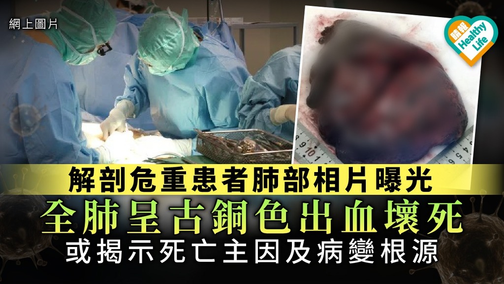 【新冠肺炎】解剖危重患者肺部相片曝光 全肺呈古銅色出血壞死 或揭示死亡主因及病變根源