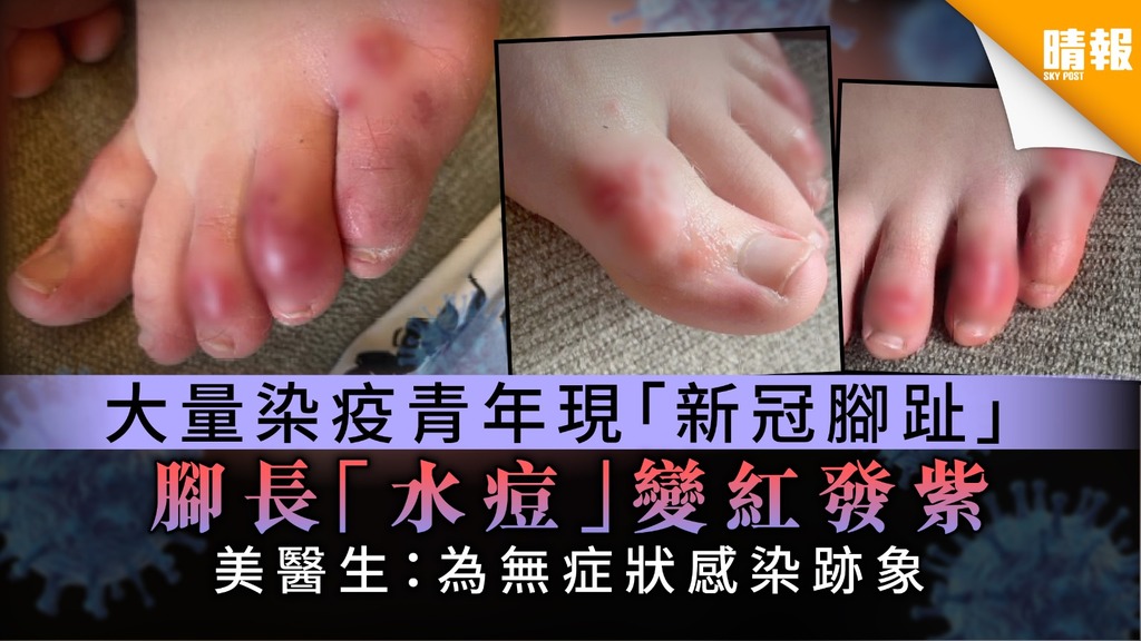 【腳病變】大量染疫青年患「新冠腳趾」長發紫「水痘」 美國醫生：為無症狀感染跡象